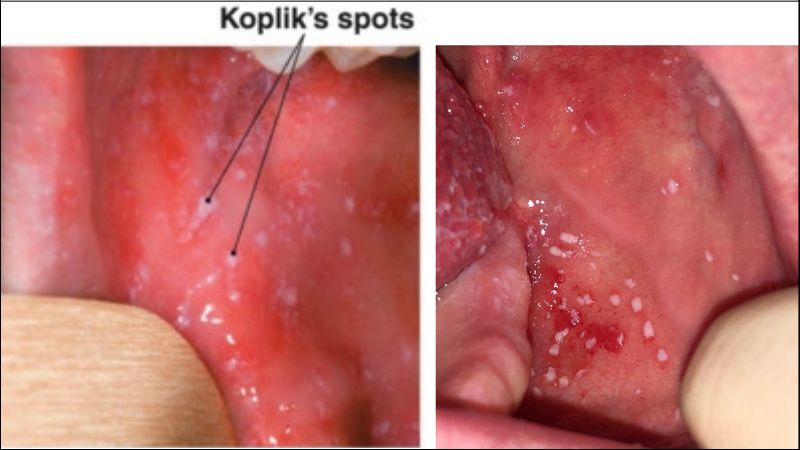 Bệnh sởi có thể khiến miệng xuất hiện những vết loét nhỏ gọi là nốt Koplik