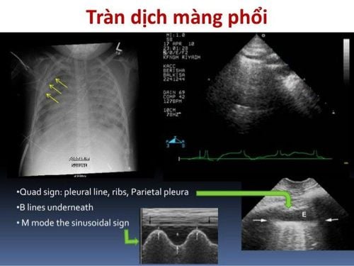 Siêu âm trong tràn khí màng phổi