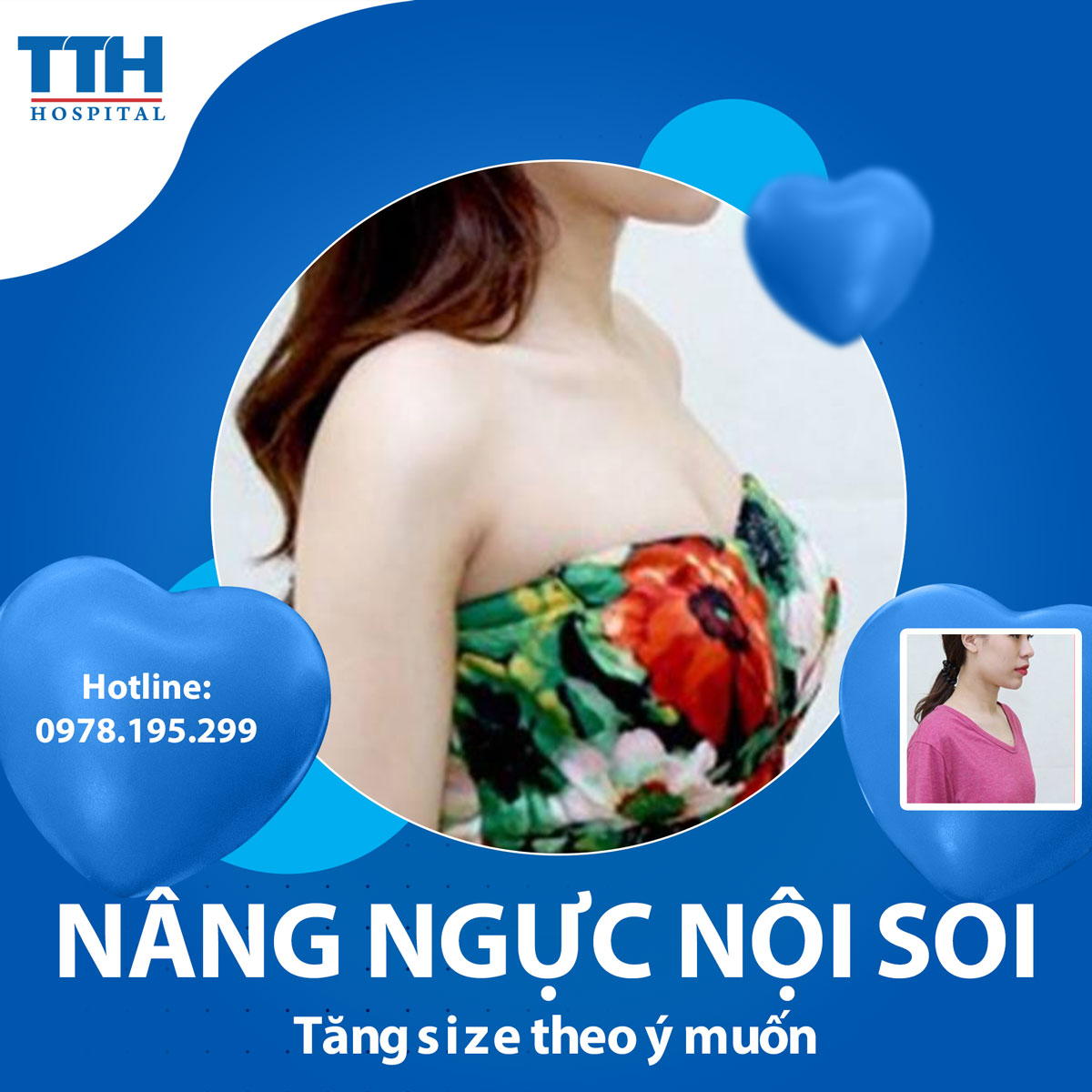 nâng ngực nội soi