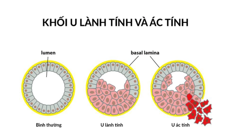 Ung bướu là gì? 2