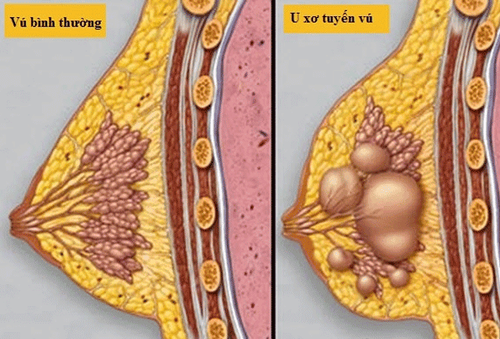 U xơ tuyến vú là loại u dễ chẩn đoán trong các u lành tính tuyến vú