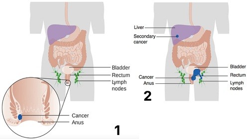 Ngược lại, nếu phát hiện và điều trị muộn, ung thư hậu môn sẽ di căn xa sang các bộ phận khác trong cơ thể như gan, hạch bạch huyết...