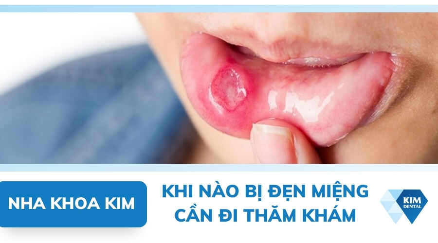 Cách trị nổi đẹn trong miệng an toàn, nhanh chóng