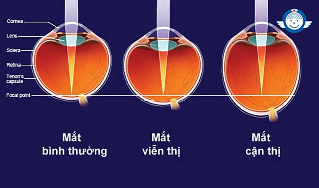 Các tật khúc xạ phổ biến