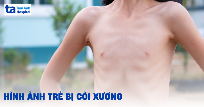 hình ảnh trẻ bị còi xương