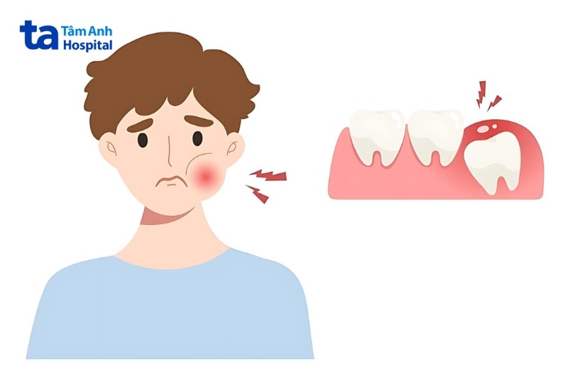 Điều trị biến chứng sau khi nhổ răng