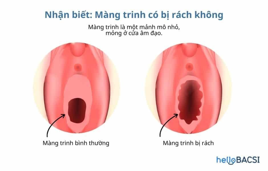 nhận biết màng trinh bị rách