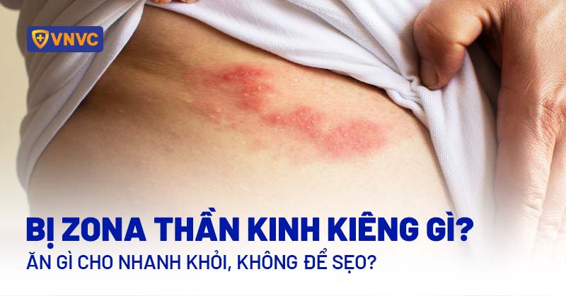 bị zona thần kinh kiêng gì