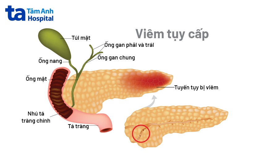 viêm tụy cấp