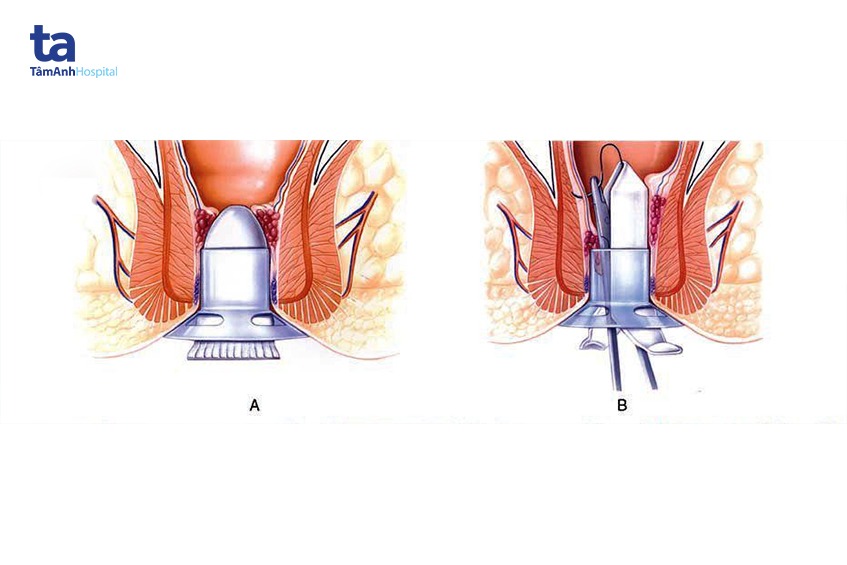 điều trị bệnh trĩ theo cấp độ