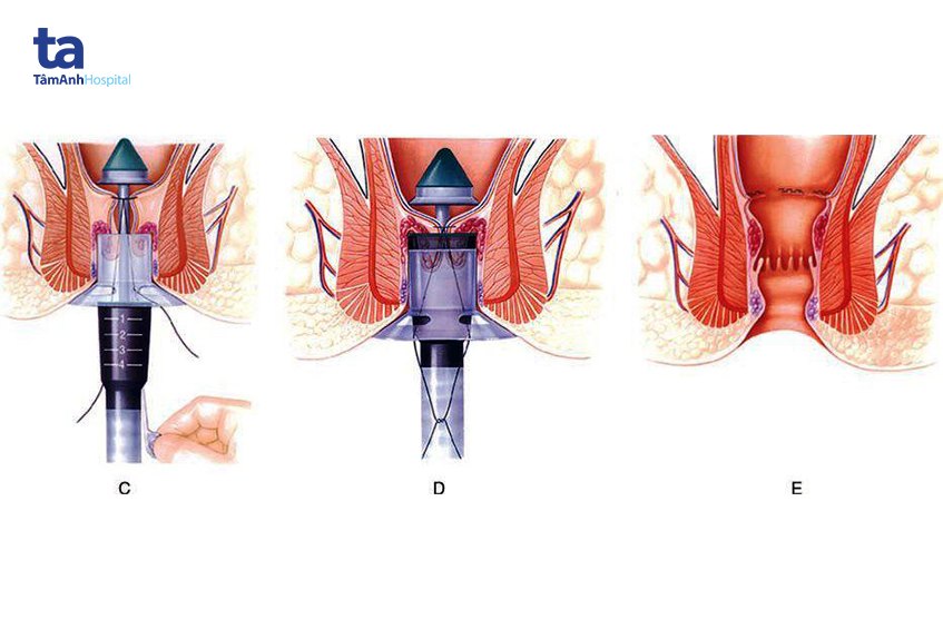 phương pháp chữa bệnh trĩ